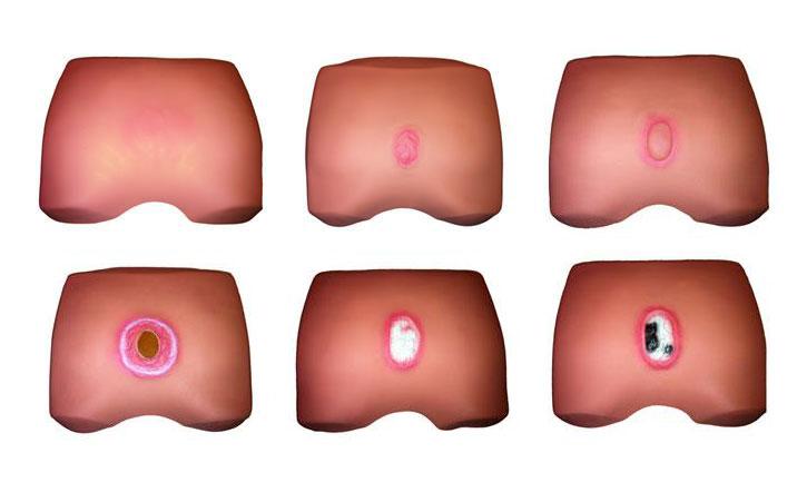 壓瘡病情演變模型?KAS-RC-1