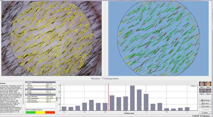 德國TrichoScan毛發(fā)分析系統(tǒng)