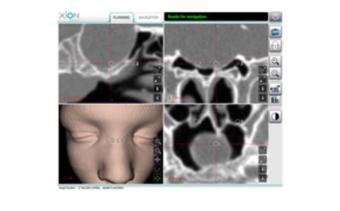 內窺鏡投射技術 內窺鏡投射技術